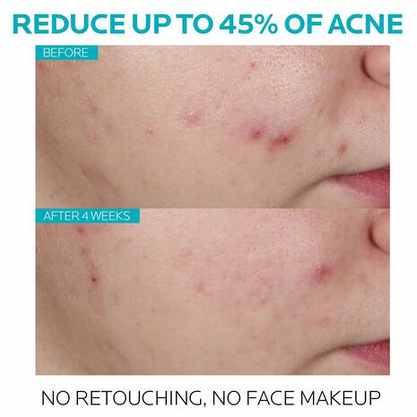 La Roche Posay Effaclar Ultra Concentrated Acne Serum 30Ml