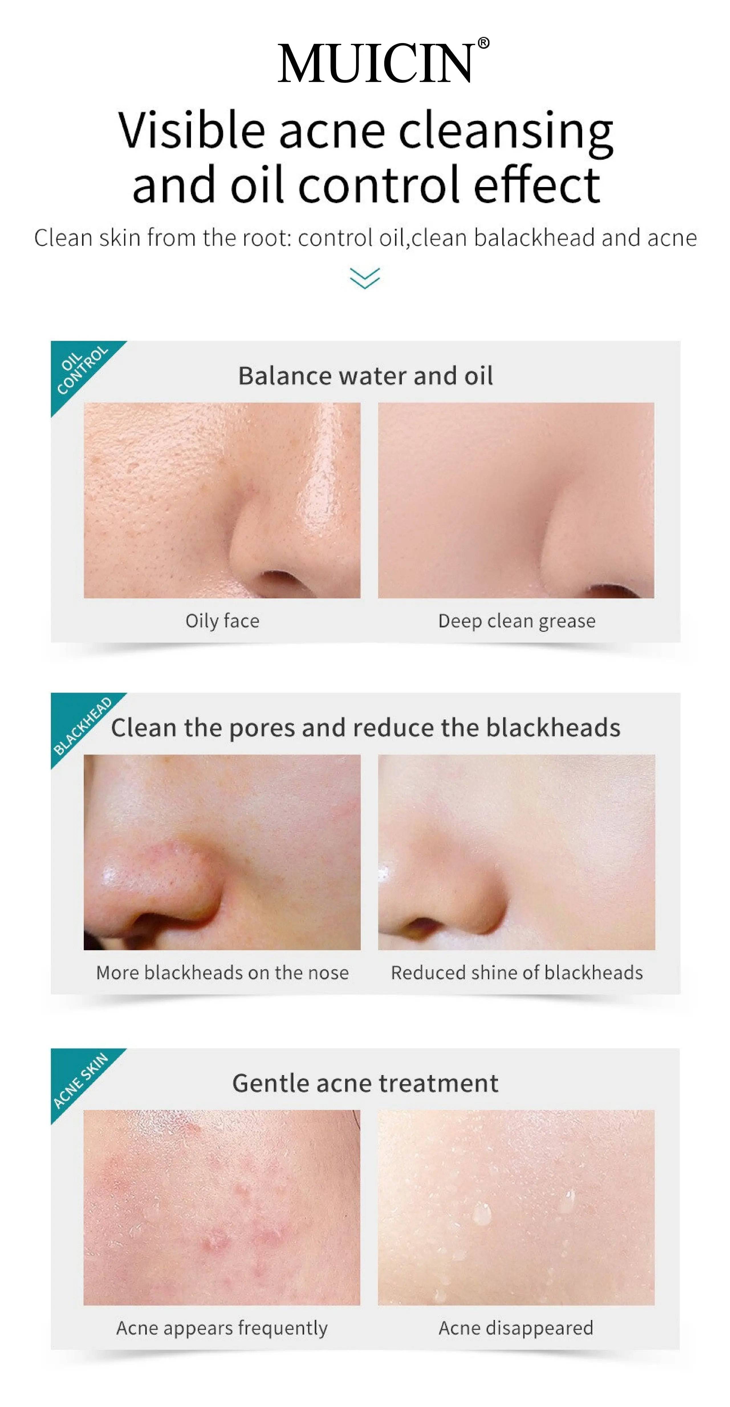 MUICIN - Tea Tree Bubble Foaming Facial Cleanser - 150ml - My Store