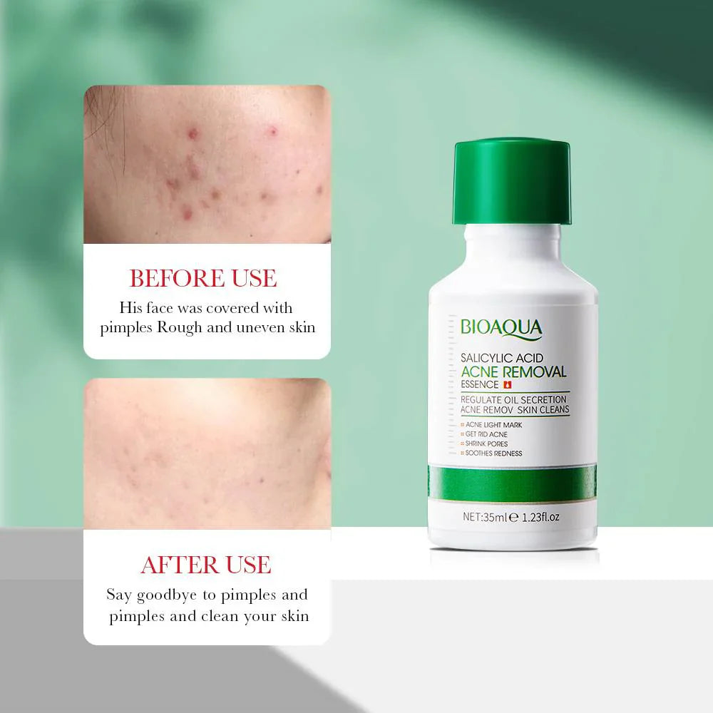 Bioaqua  Salicylic Acid Acne Removal 35Ml